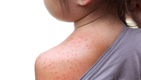 Vaccination contre la rougeole: hausse des cas de rougeole au Québec